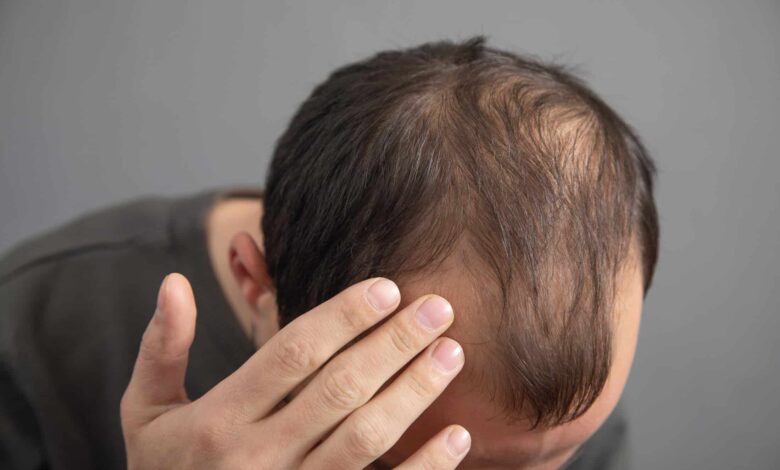 Novo estudo pode ser a chave para a cura da calvície