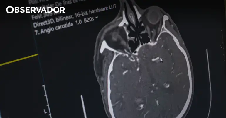 Hospital de Ponta Delgada trata AVC com tecnologia de IA