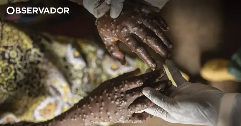 Guiné-Bissau confirma primeiro caso de mpox