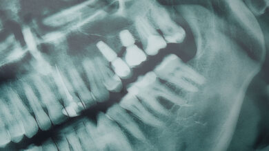 USP desenvolve IA que ajuda dentistas a detectar cáries em radiografias