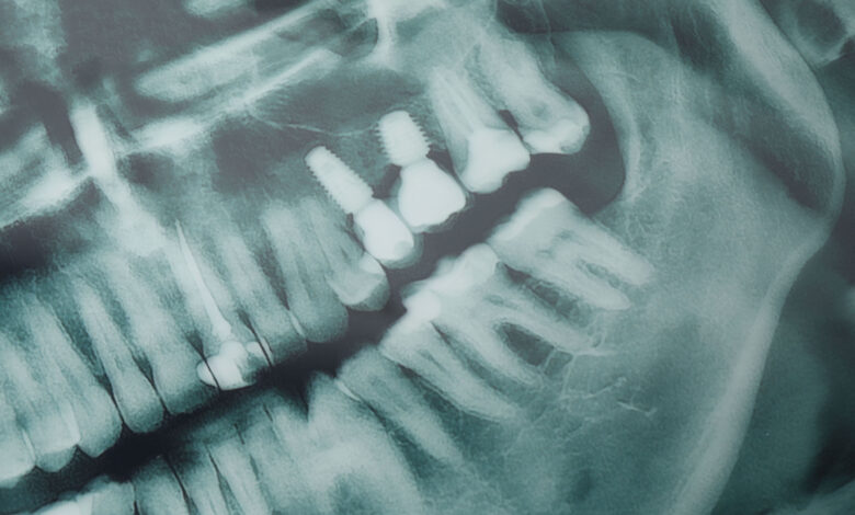 USP desenvolve IA que ajuda dentistas a detectar cáries em radiografias