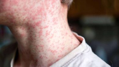 Nenhum estado brasileiro atinge meta de vacinação contra o sarampo